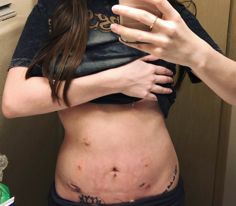 person with endometriosis lifting their shirt and showing surgery scars