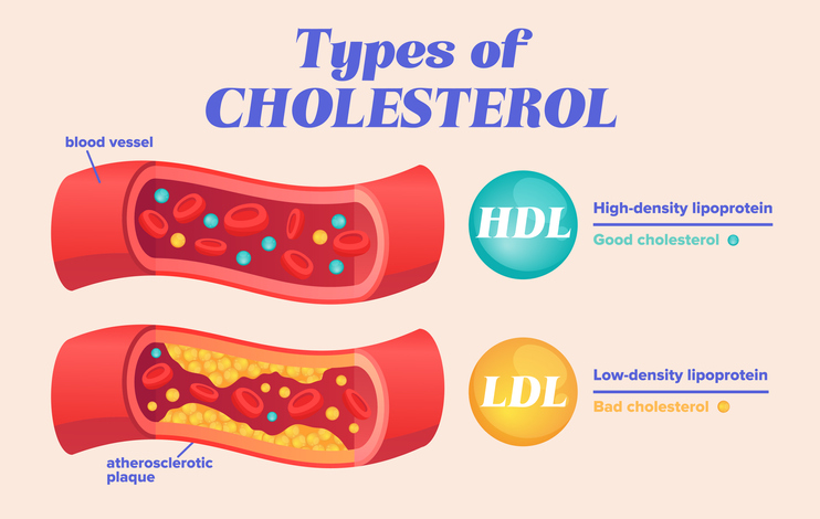 Types of cholesterol 